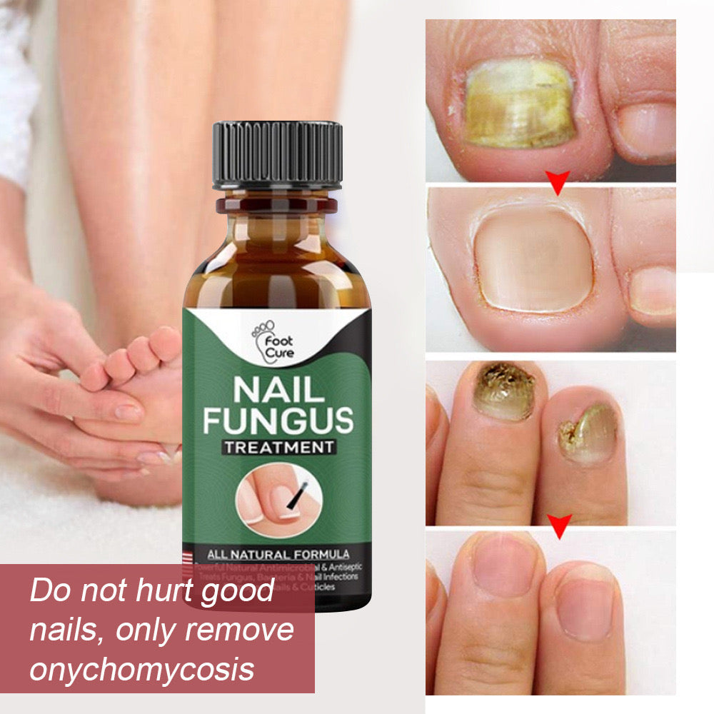 100% Original Nail Fungus Treatment Stop Fungal Growth Effective Fingernail 10ml